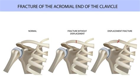 20 Acromial End Of Clavicle Images, Stock Photos, 3D objects, & Vectors | Shutterstock