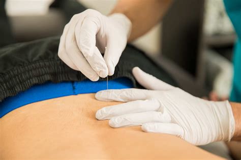 The Benefits Of Dry Needling For Athletes Fargo Spine