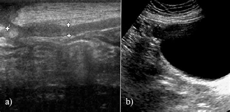 A Patent Urachus In A 25 Day Old Infant With Fluid Discharge Through