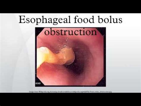 Glucagon For Food Bolus - Paling Baru Food Bolus Definition - Alexandra ...