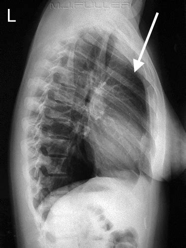 Interpreting A Chest X Ray Stepwards