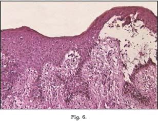 Enfermedad De La Mucosa Oral Penfigoide De Las Membranas Mucosas