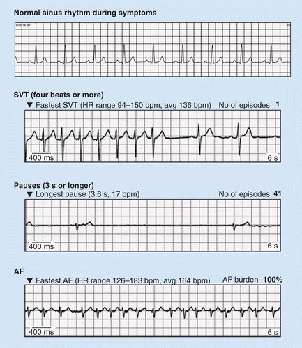 Day Holter Monitor Cpt Kawevqanime