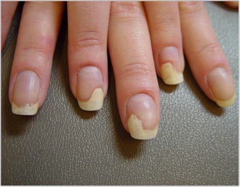 Nail Separating From Nail Bed Nails Magazine