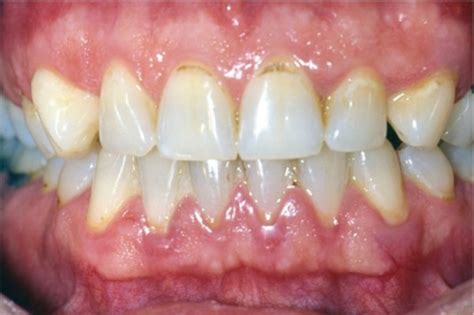 gingival description Flashcards | Quizlet