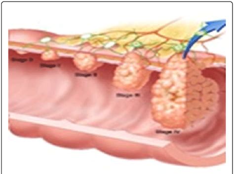 Colon Cancer Staging Chart