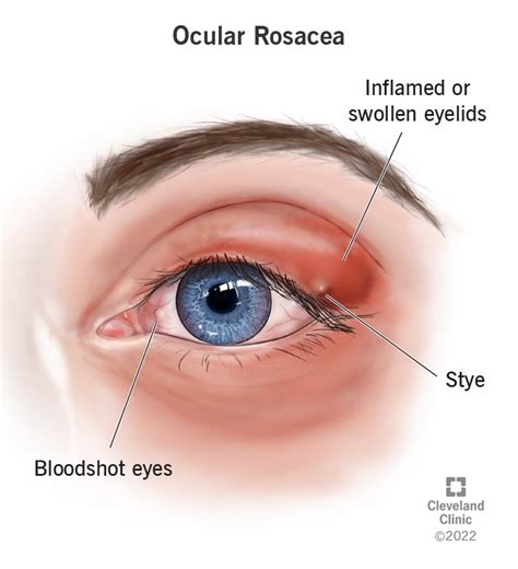 Rosacea Around The Eyes