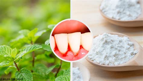 5 Remedios Caseros Efectivos Para La Gingivitis Mejor Con Salud