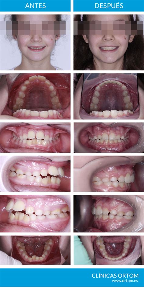 Momento Ideal Para Poner Brackets Cl Nicas Ortodoncia Ortom