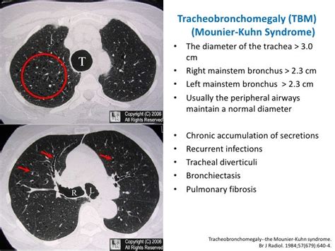 Dynamic Central Airway Obstruction Tracheomalacia Tracheobronchomal