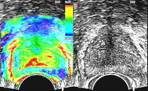 Role Of Transrectal Ultrasonography In Prostate Cancer Radiologic Clinics