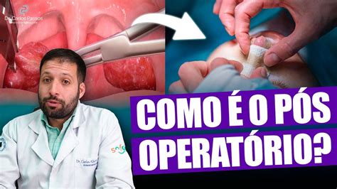 DOR NO PÓS OPERATÓRIO DA CIRURGIA DA ADENOIDE E DAS AMIGDALAS YouTube