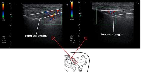 Peroneal Tendinopathy Ankle Foot And Orthotic Centre