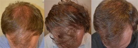 Four Year Finasteride Hair Thickening Result Hair Restoration Of The South