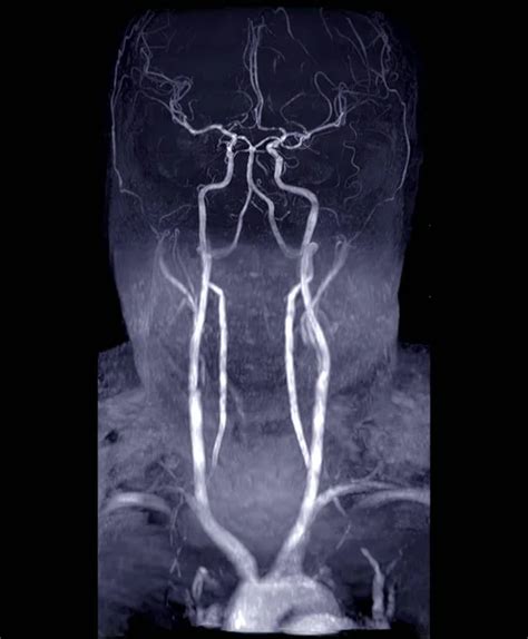 Arm Angiografía De Cerebro Y Cuello O Resonancia Magnética Arm De La