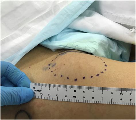 Onset Of Chronic Expanding Hematoma 25 Years After Total Hip Arthroplasty Arthroplasty Today