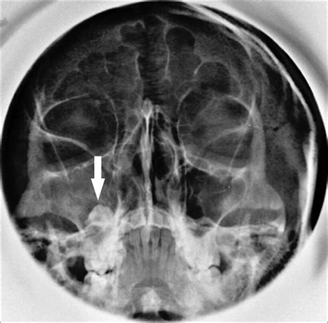 Infected Dentigerous Cyst Of Maxillary Sinus Arising From An Ectopic