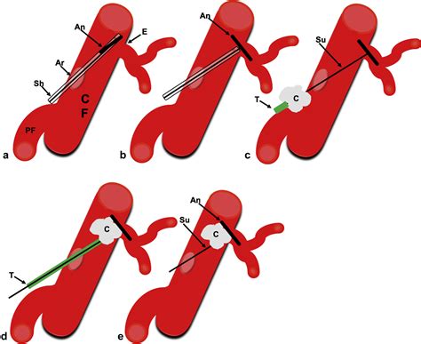 Intravascular Deployment Of An Angio Seal Device With Successful