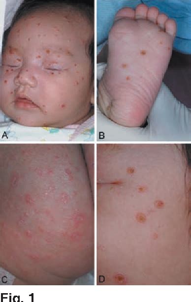 Langerhans Cell Histiocytosis Skin