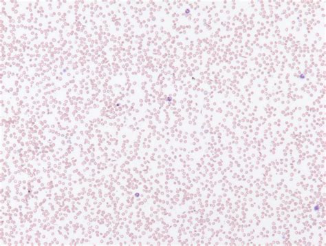 Peripheral smear quiz • The Blood Project