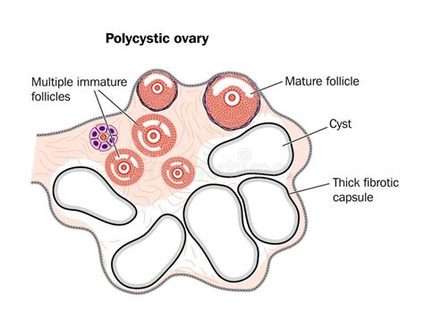 Polycystic Ovary Syndrome Stock Vector Illustration Of Infertility