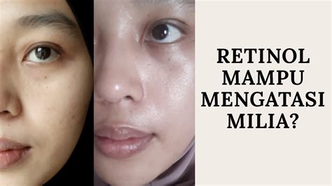 Cara Mengatasi Milia Review Retinol Somethinc Somethinc Retinol Untuk Anti Aging Youtube