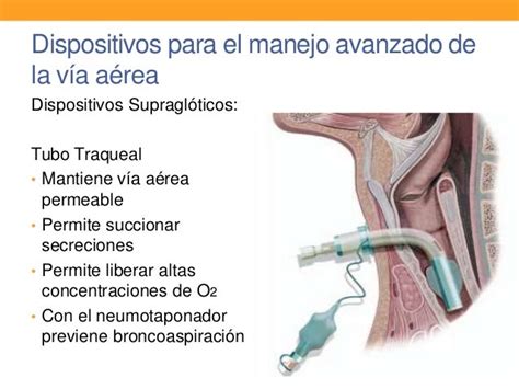 Manejo De La Vía Aérea En Reanimación Avanzada