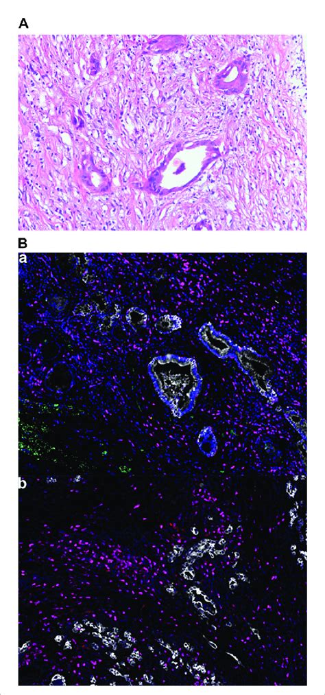 Tumor Pathological Findings A Hematoxylin And Eosin Staining Of The Download Scientific