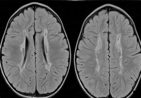 Periventricular Leukomalacia