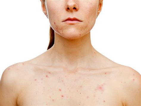 Frightening Reasons Your Skin Is Breaking Out - Boldsky.com