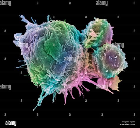 T Lymphocytes And Cancer Cell Coloured Scanning Electron Micrograph