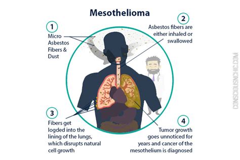 In the know: Symptoms of Mesothelioma Cancer - Conscious & Chic