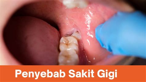 Mengungkap 10 Penyebab Sakit Gigi Apa Saja Agen Propolis Melia