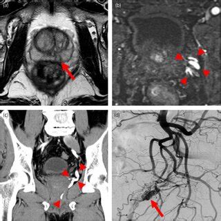 Imaging performed in Case 1: (a, b) MRI performed before prostate ...