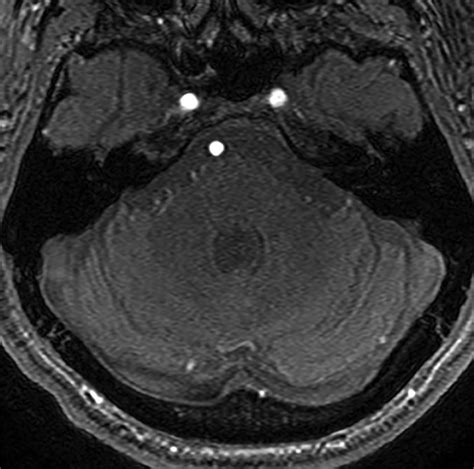 Contemporary Imaging Of Cerebral Arteriovenous Malformations Ajr