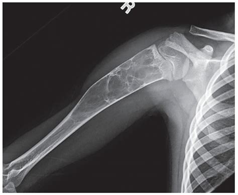 Tumors Musculoskeletal Key