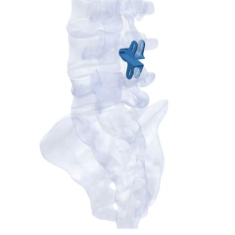 interspinous device octans  madison ortho