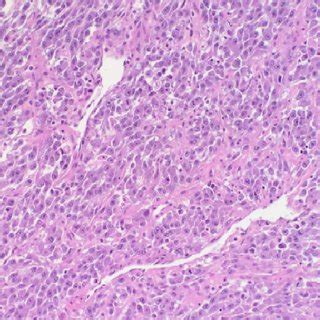 Microscopic Examination Reveals High Grade Urothelial Carcinoma