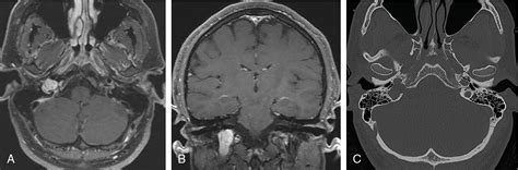 Jugular Foramen Schwannoma Upfront Radiosurgery Radiology Key