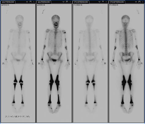 Whole Body Technetium Tc99m Bone Scintigraphy Performed Before