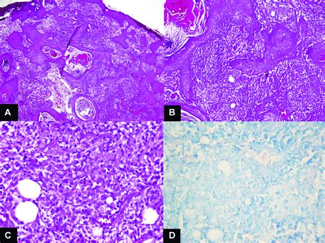 A Low Power View Of Biopsy Showing Pseudoepitheliomatous Hyperplasia