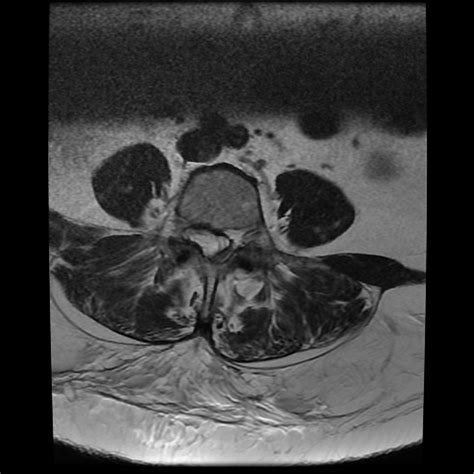 Lumbar Spinal Synovial Cyst Image