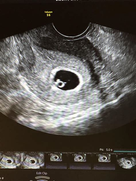 6 Week Ultrasound