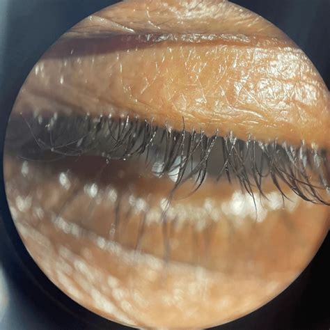 Demodex Blepharitis Xdemvy® Lotilaner Ophthalmic Solution 025