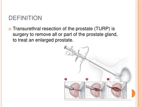 Nursing Transurethral Resection Of The Prostate