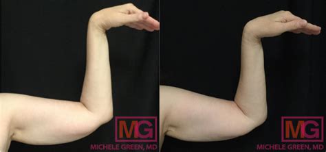 Solutions For Flabby Arms