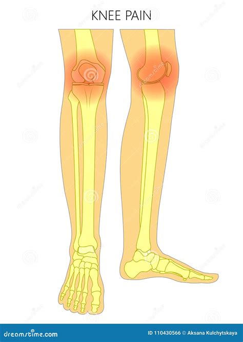 Synovitis Inflammation Of The Synovial Membrane Knee And Synovial