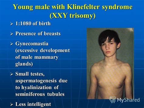 Genetic Causes Of Klinefelter Syndrome Images