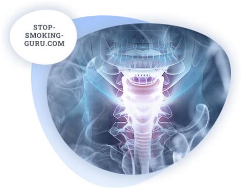 Larynx cancer | Stop-smoking-guru.com