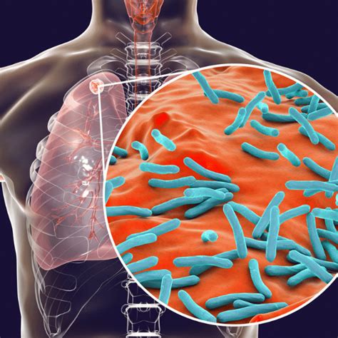 Tuberculosis (TB) testing for employee screening